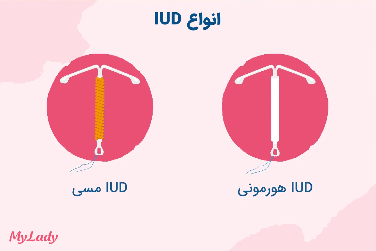 انواع دستگاه IUD