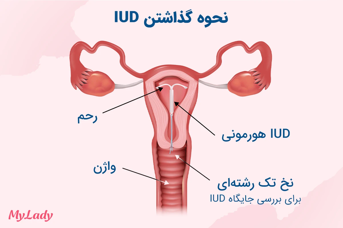 نحوه گذاشتن IUD دستگاه ضد بارداری