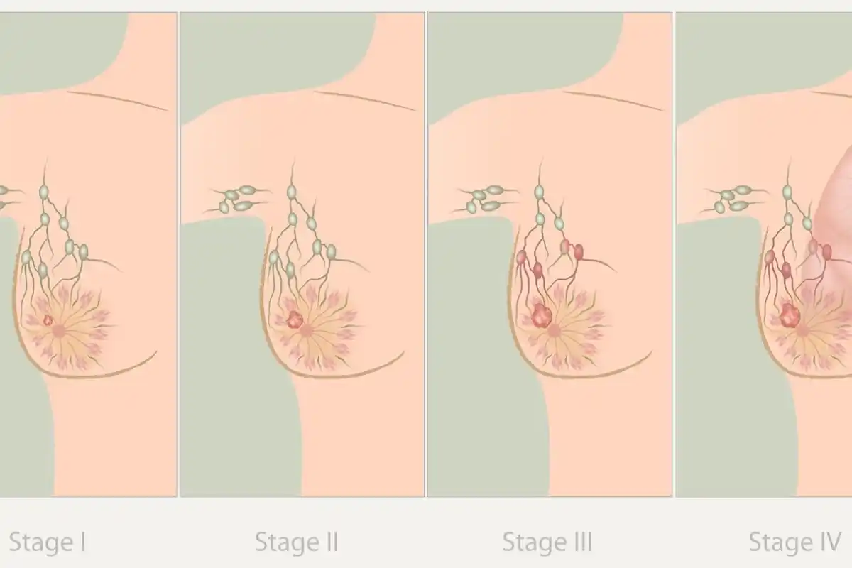 مراحل سرطان سینه در زنان