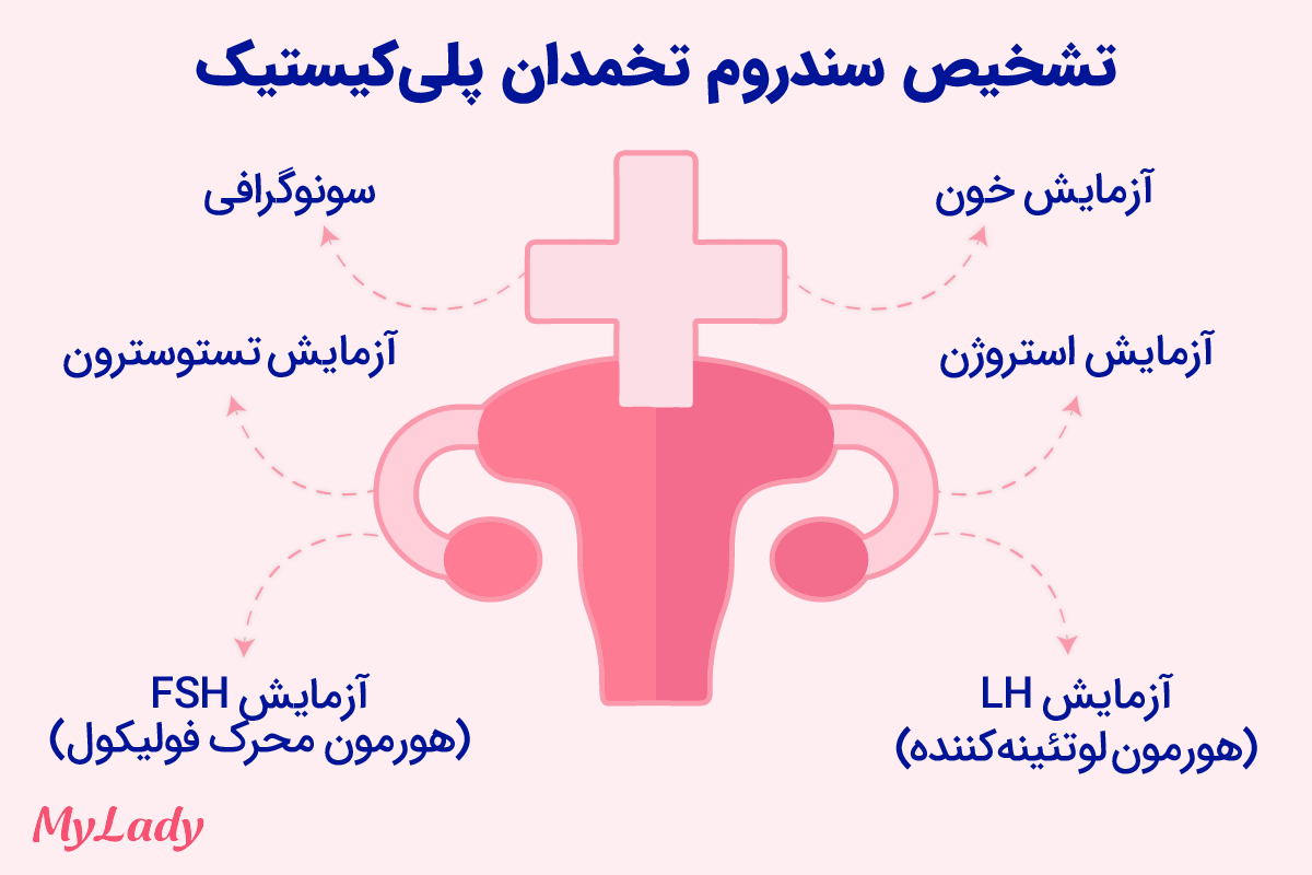 تشخیص سندرم تخمدان پلی کیستیک