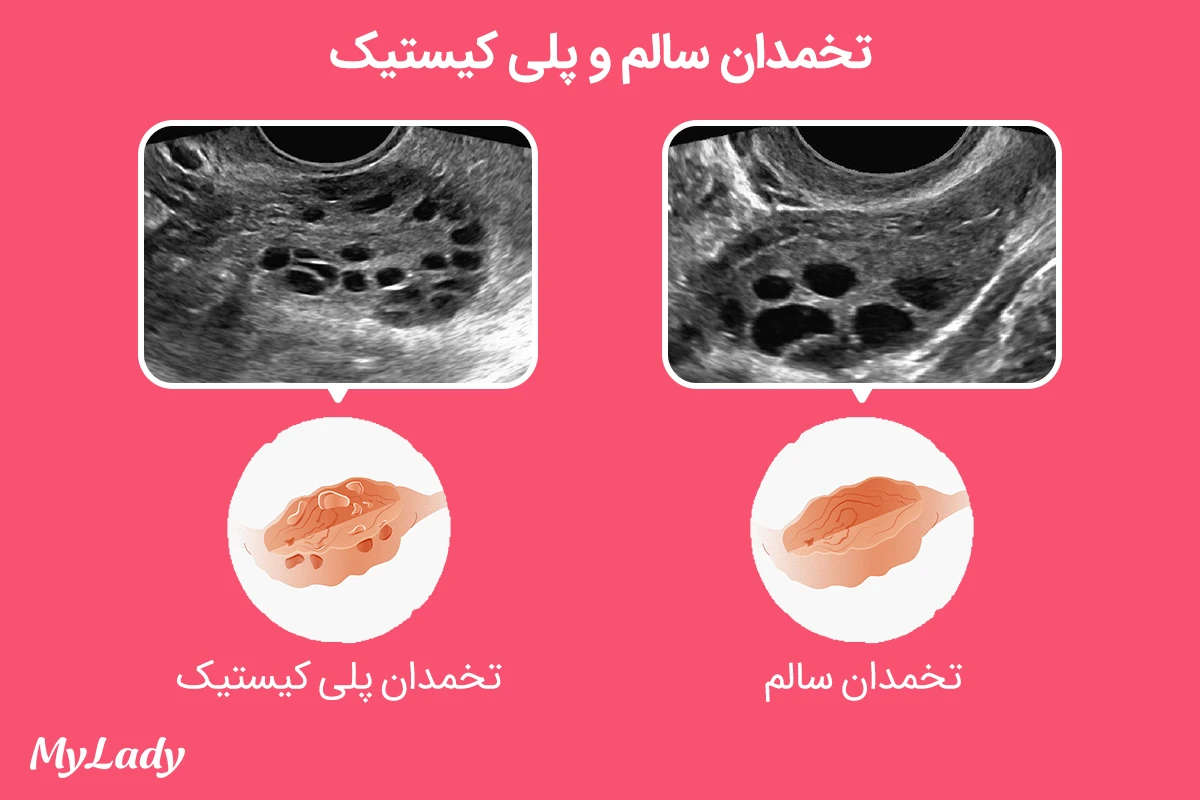 عکس تخمدان پلی کیستیک در سونوگرافی