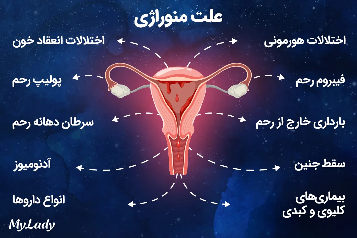 علت منوراژی یا هایپرمنوره