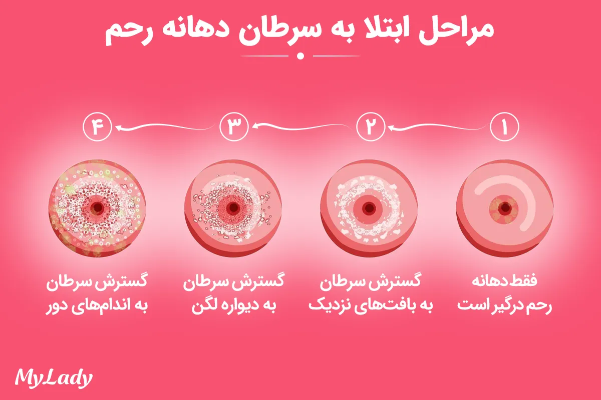 مراحل سرطان دهانه رحم